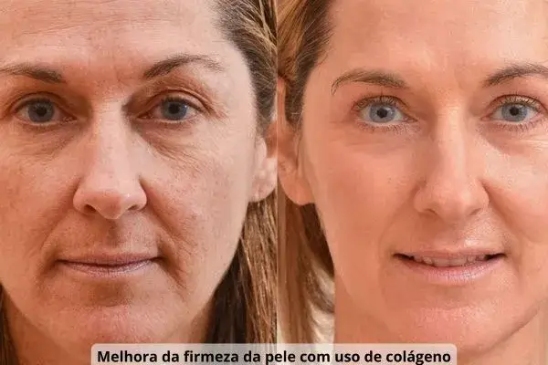 melhora da firmeza da pele com uso de colágeno